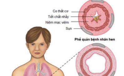 Thuốc cần thiết cho người bệnh hen